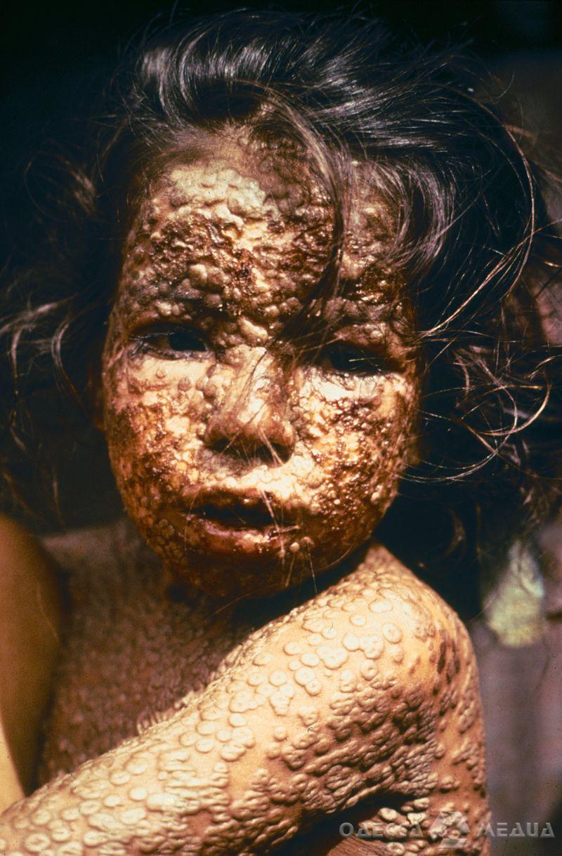 800px Child with Smallpox Bangladesh